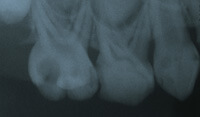 C3：町田の歯医者・歯科｜みどりの森デンタルクリニック町田の小児歯科治療
