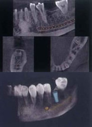 コンピューター上で骨を再現できる：町田の歯医者・歯科｜みどりの森デンタルクリニック町田の顎関節症・歯ぎしり・食いしばり