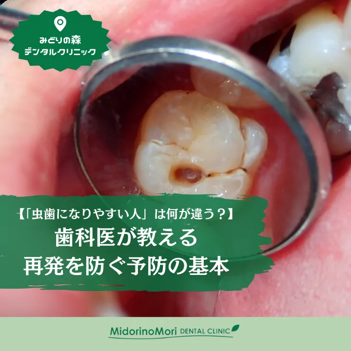 2026年3月6日_「虫歯になりやすい人」は何が違う？歯科医が教える再発を防ぐ予防の基本